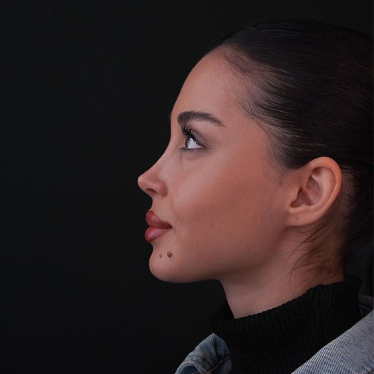 Rhinoplasty